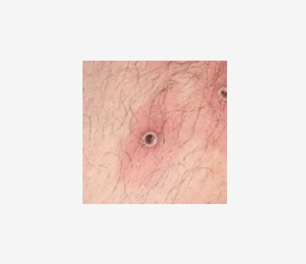 Fotos del sarpullido de la viruela símica (mpox en inglés)